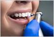 Limpeza de dente o que é, benefícios e quanto custa